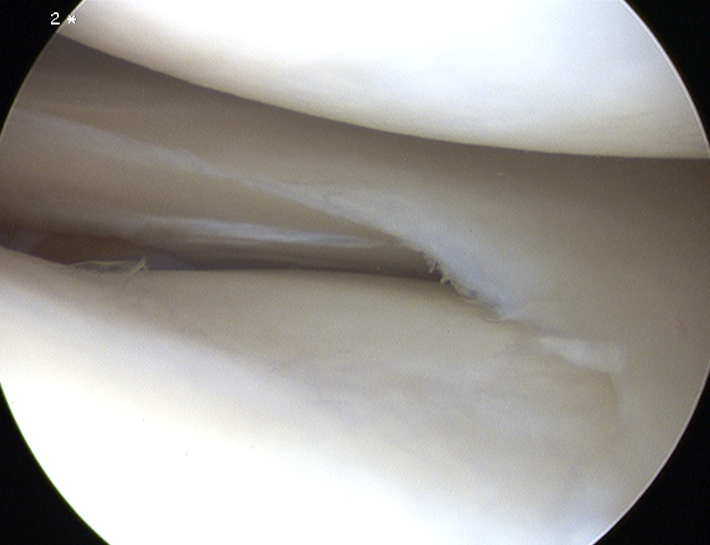 Knee Arthroscopy Healed Meniscal Tear Undersurface Lateral Meniscus